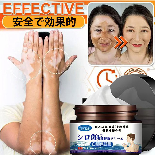 ဖလိုရိုက် Vitiligo ခရင်မ်